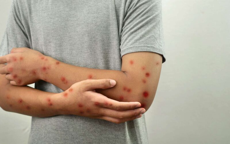 Alerta Sanitário: Mpox persiste no Brasil e casos são confirmados no Rio de Janeiro